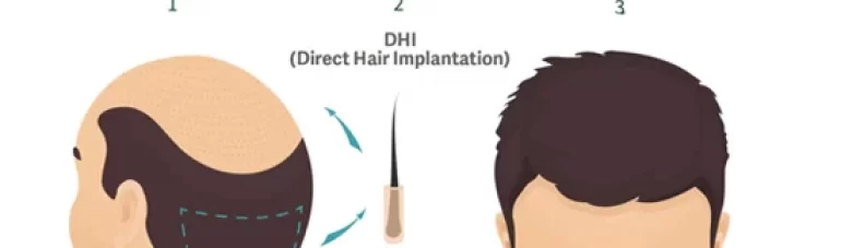 dhi-hair-transplant-procedure